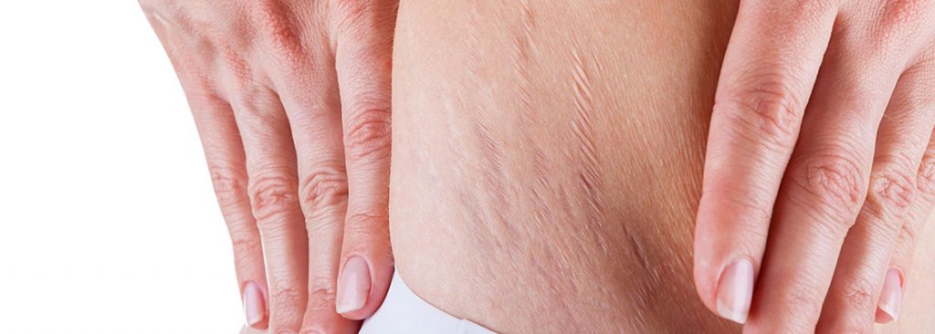 Benefits of laser stretch marks removal